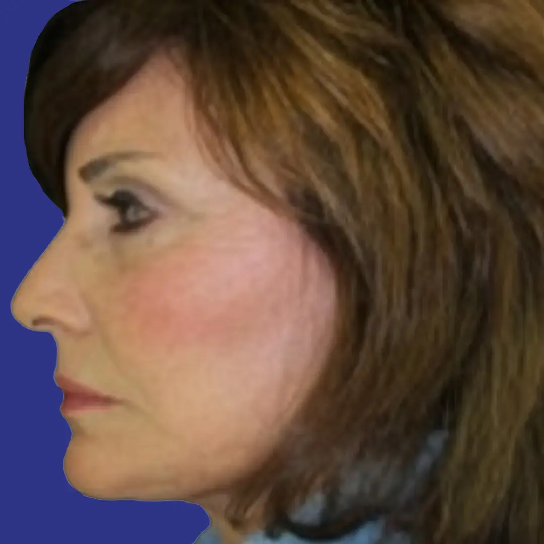 Procedure before and after - after