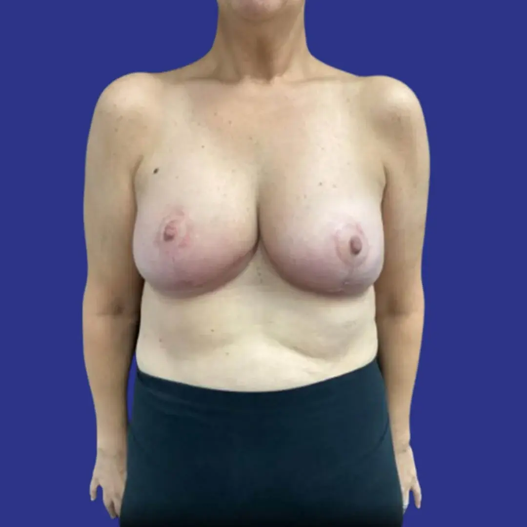 Procedure before and after - after