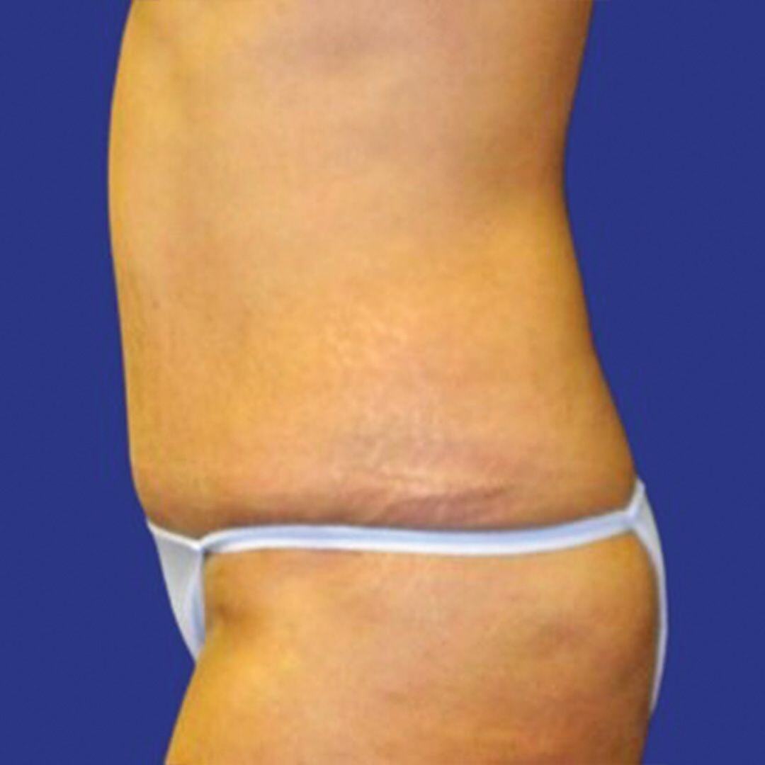 Procedure before and after - after