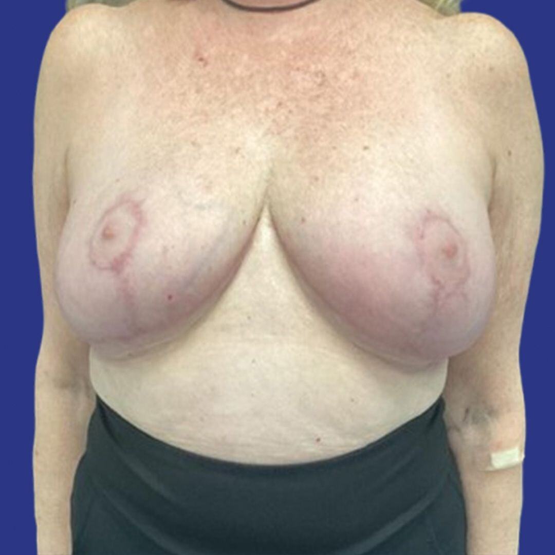 Procedure before and after - after