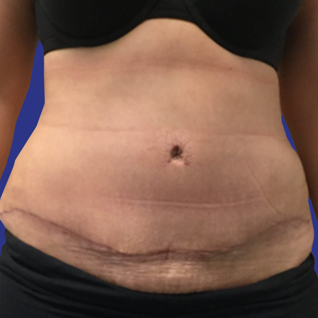 Procedure before and after - after