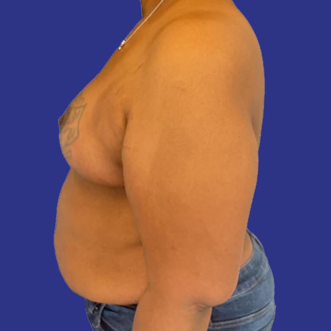 Procedure before and after - after