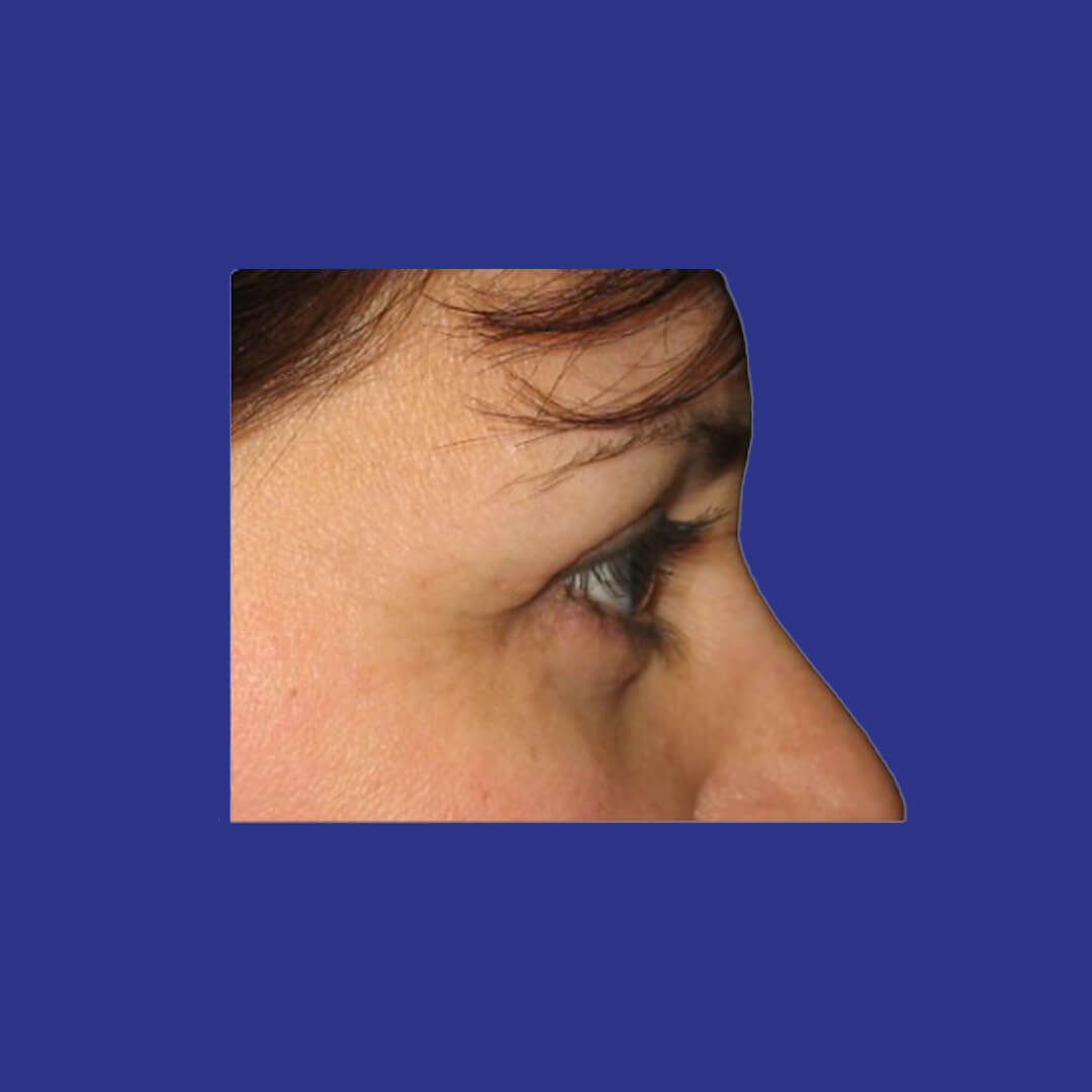 Procedure before and after - after