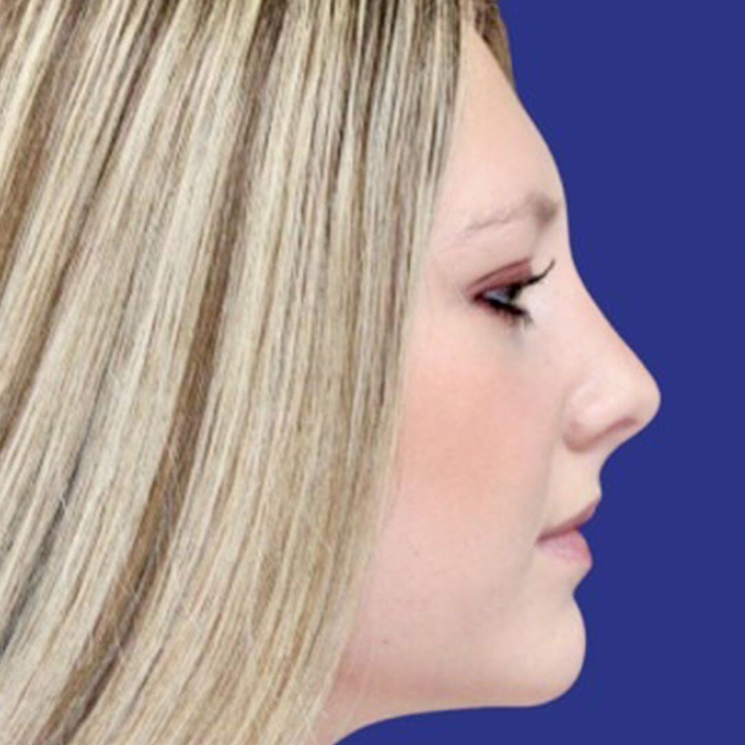 Procedure before and after - after