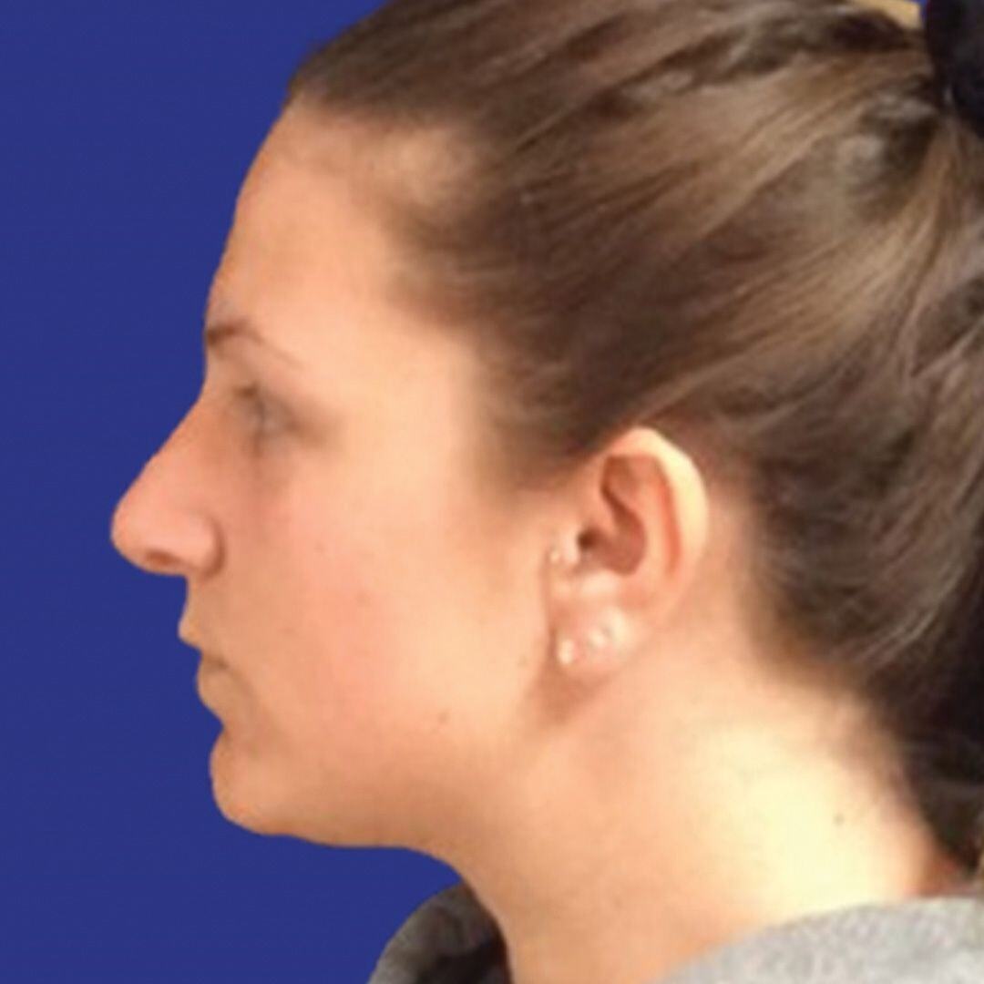 Procedure before and after - after