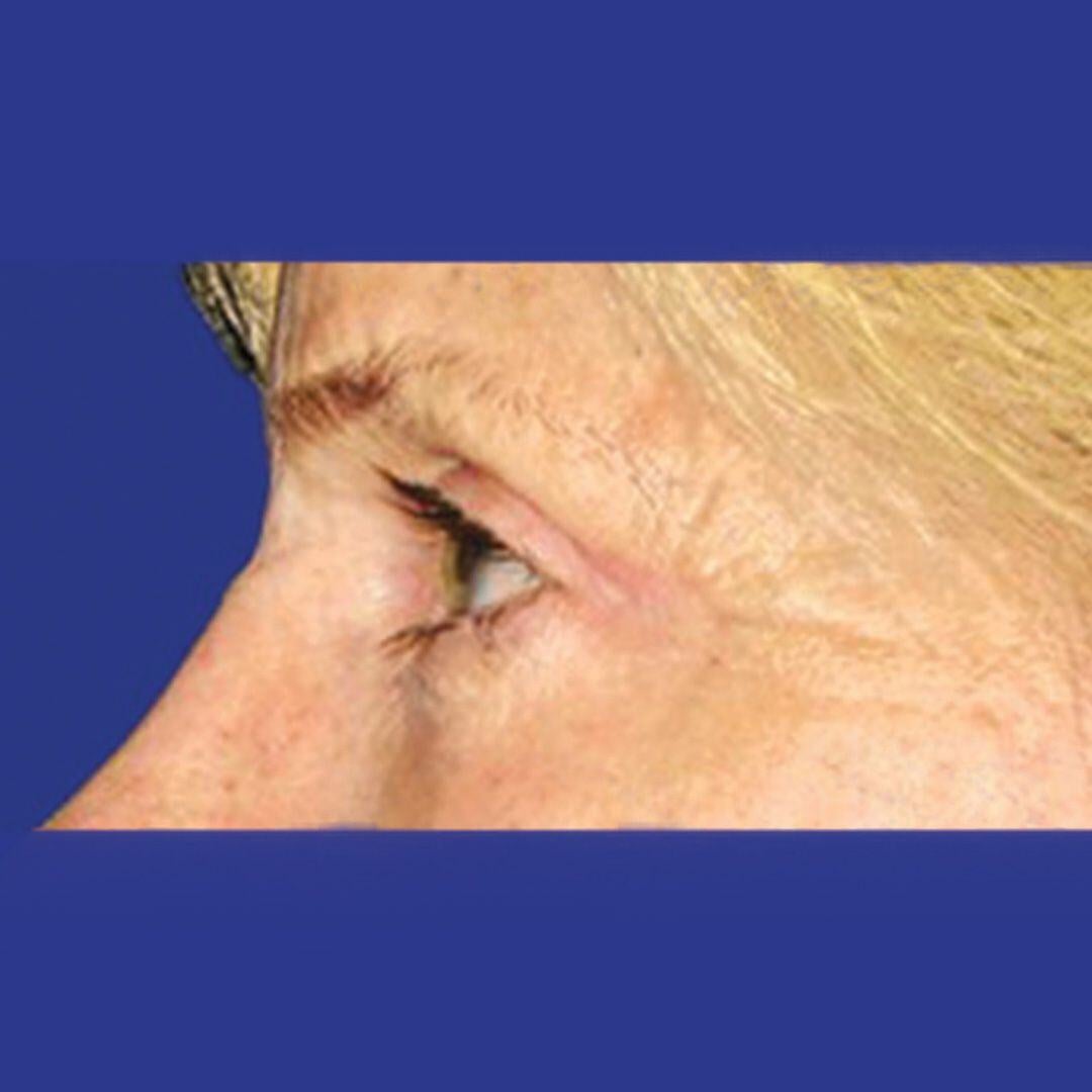 Procedure before and after - after