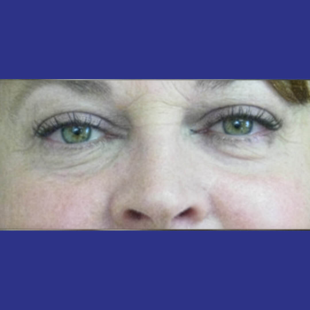 Procedure before and after - after