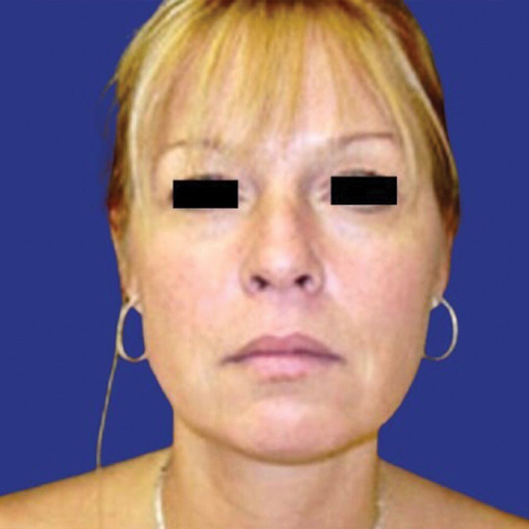 Procedure before and after - after