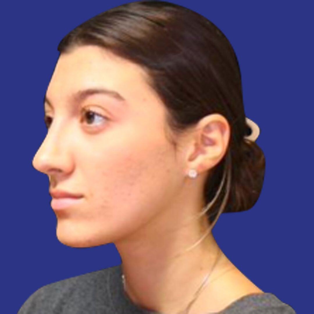 Procedure before and after - after