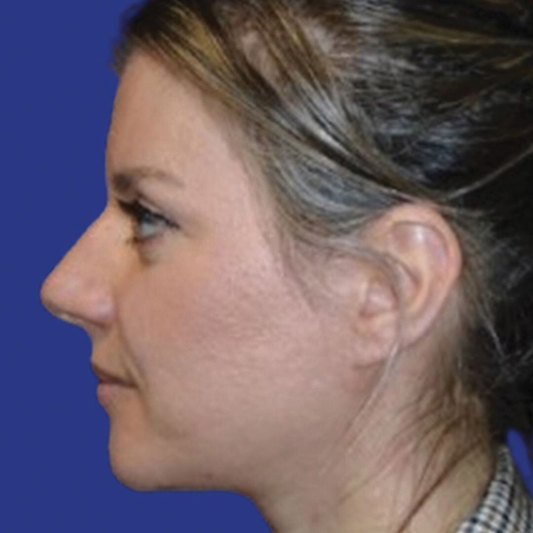 Procedure before and after - after