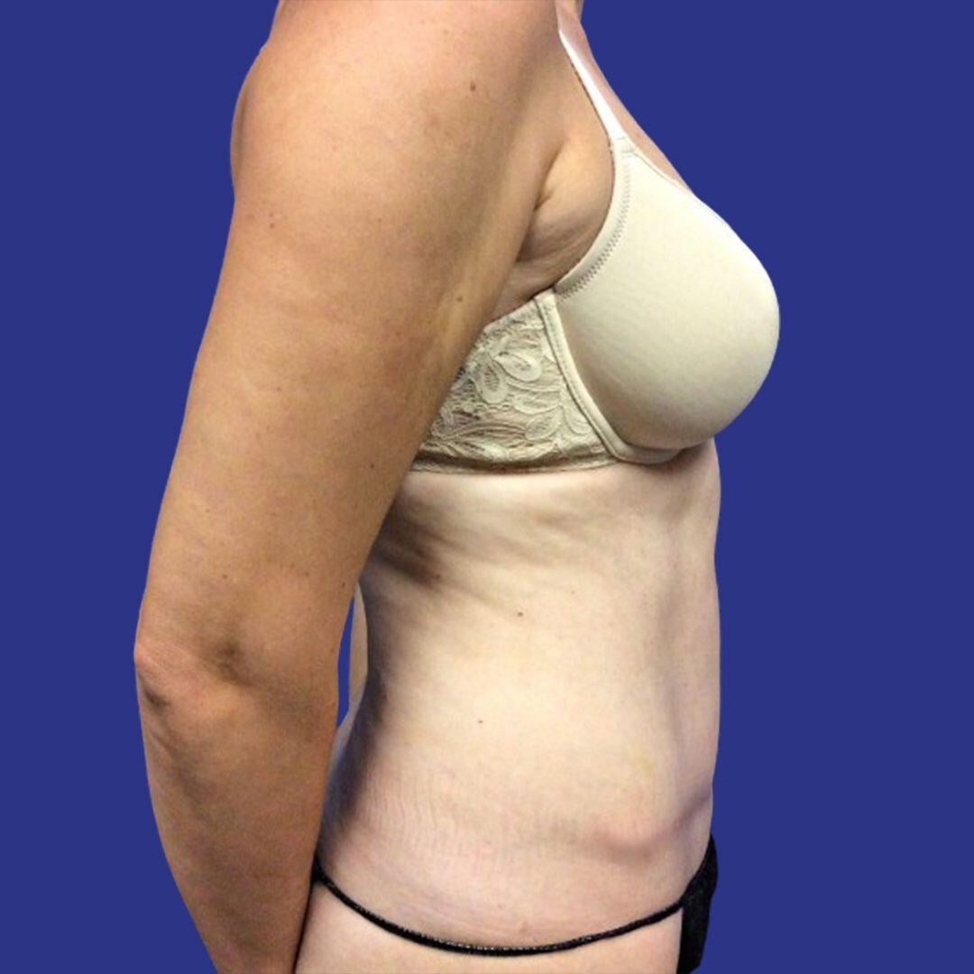 Procedure before and after - after