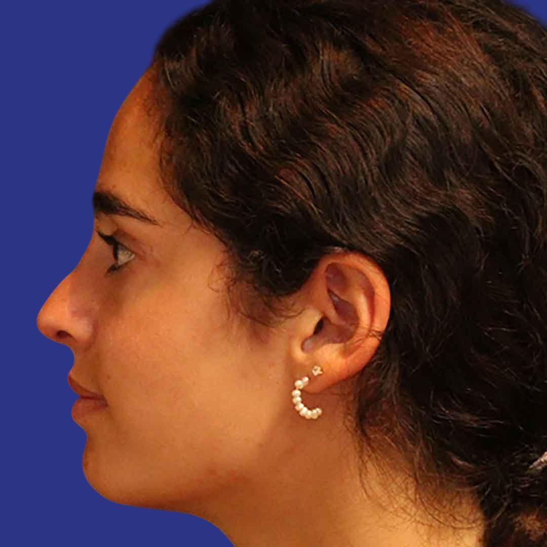 Procedure before and after - after