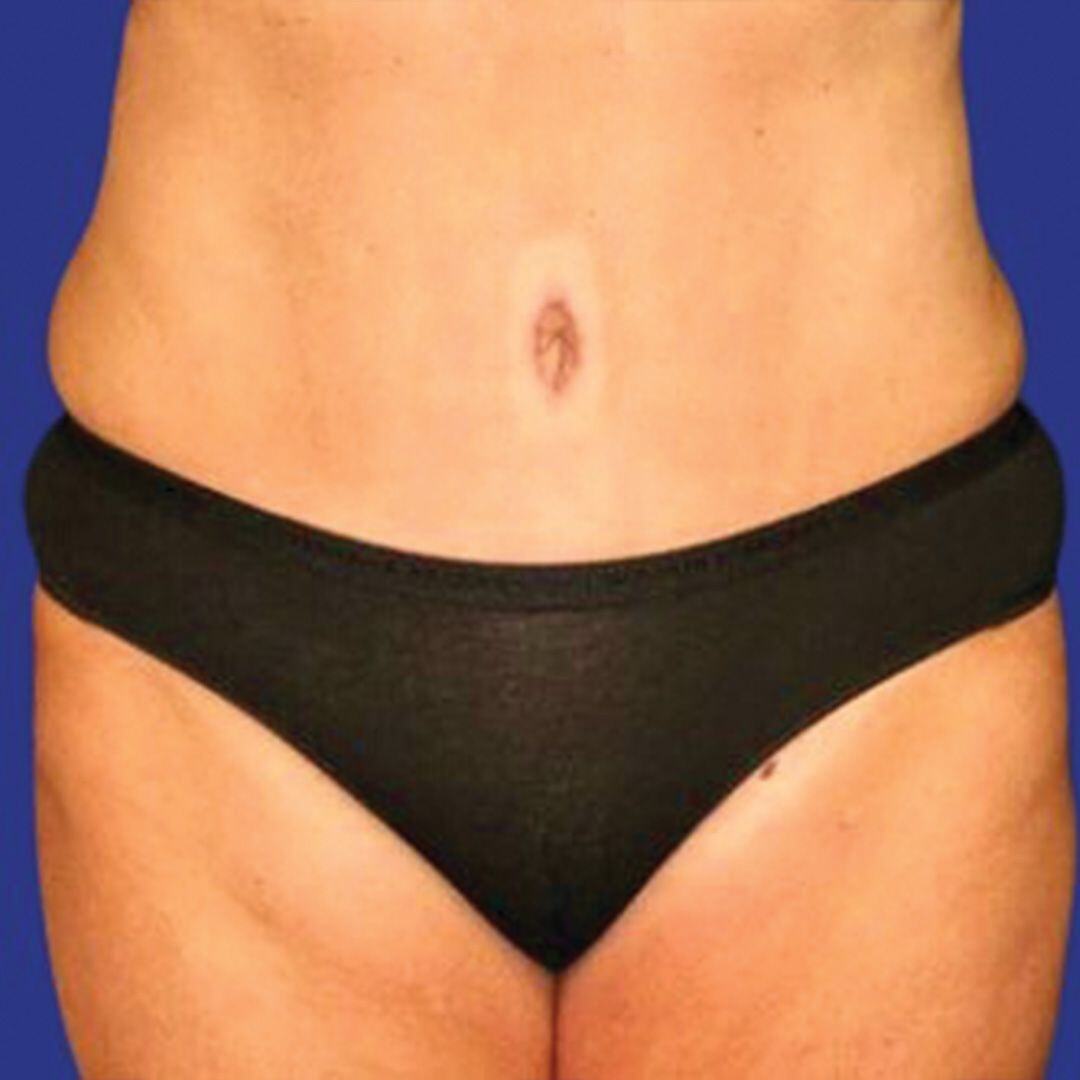 Procedure before and after - after