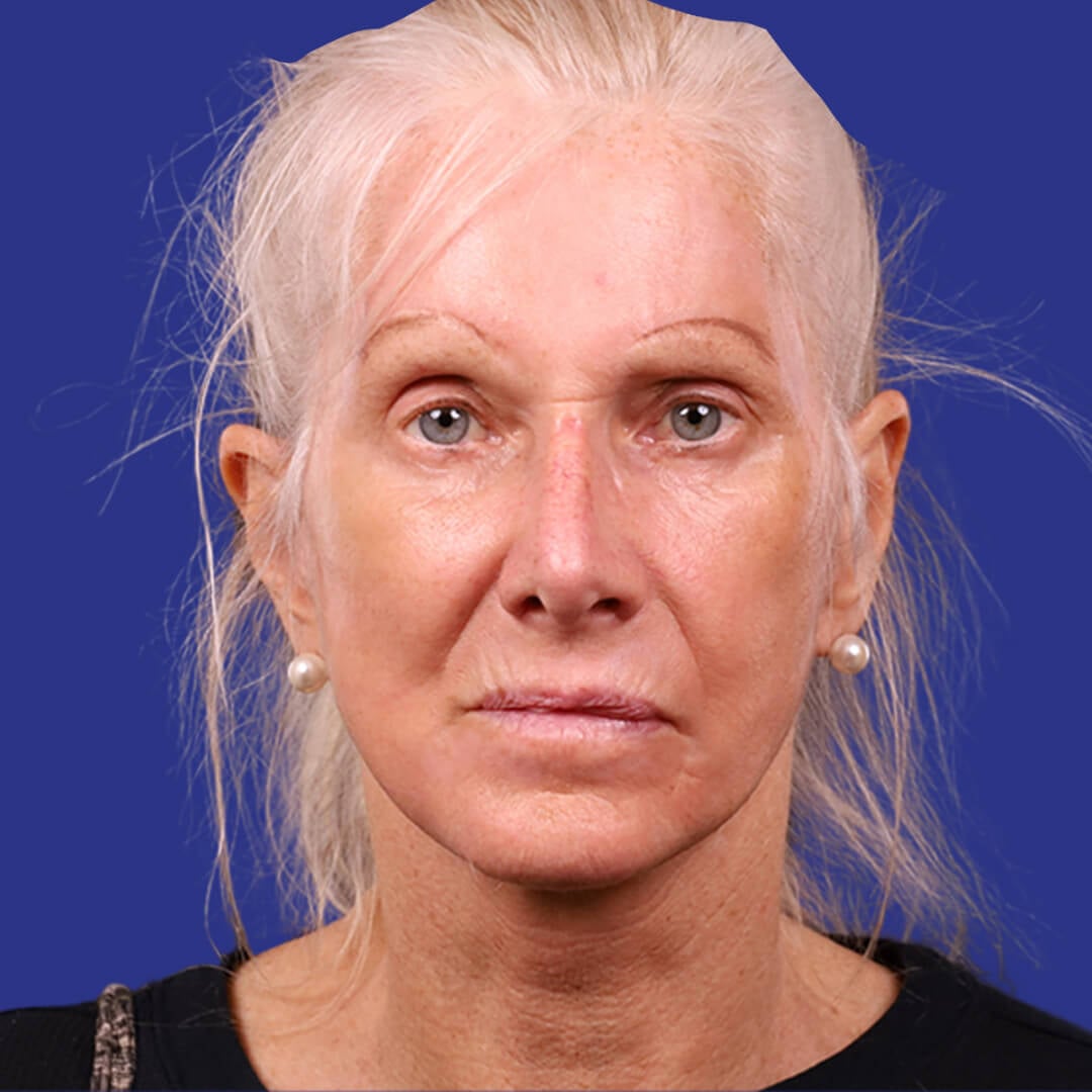 Procedure before and after - after