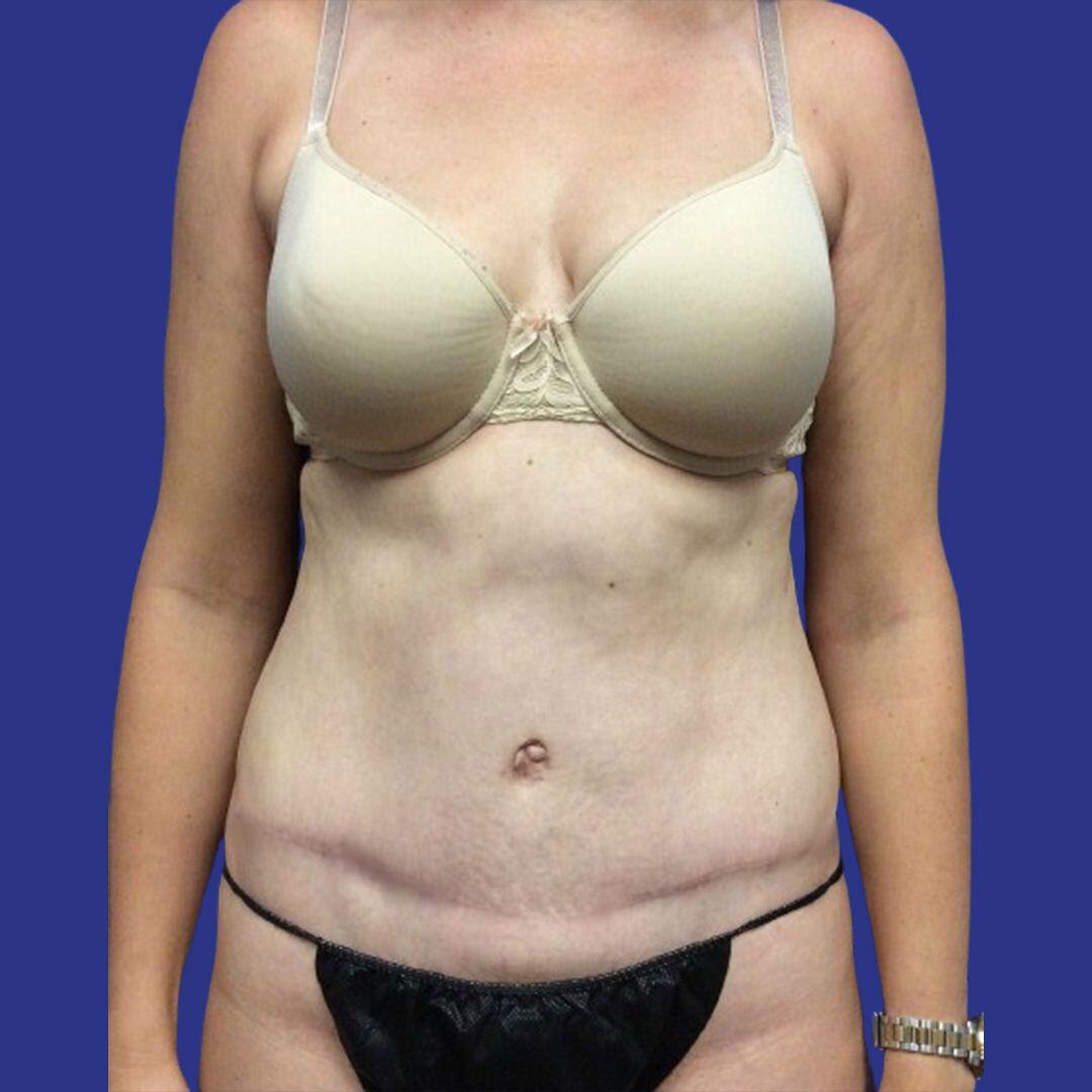 Procedure before and after - after