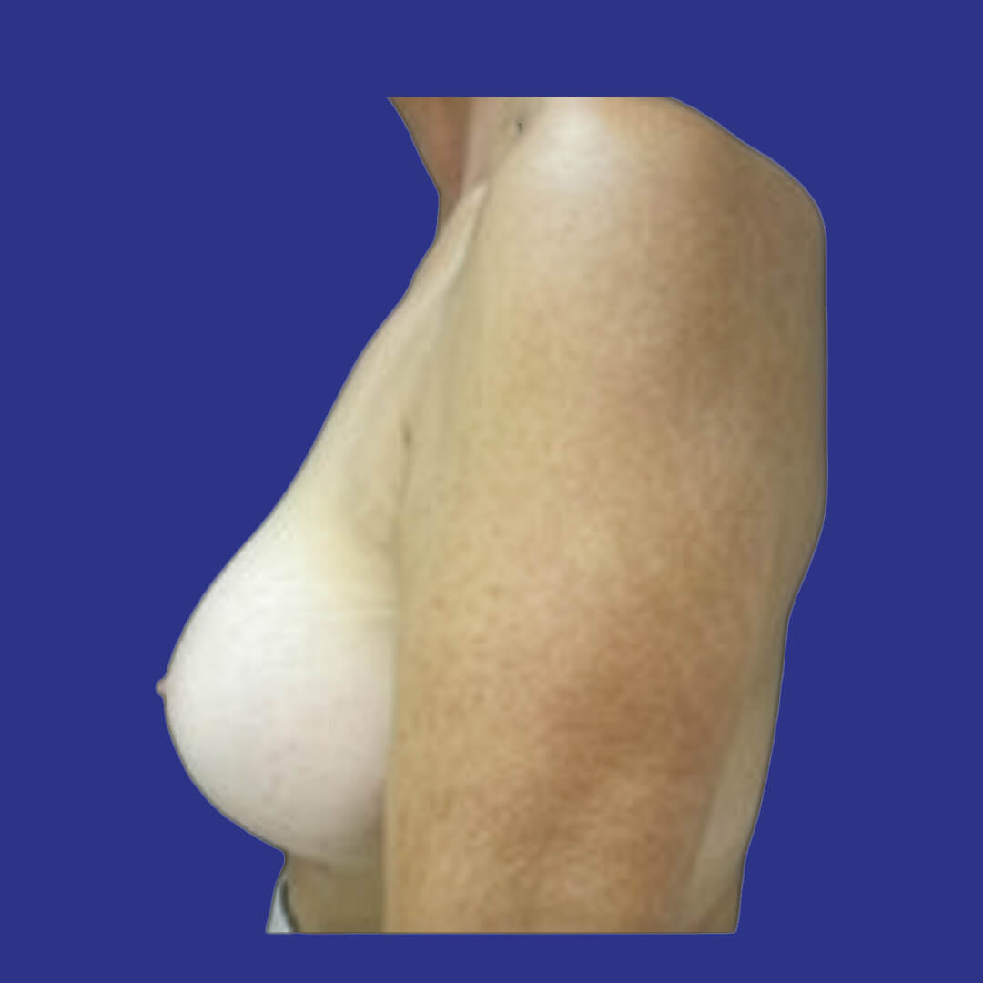 Procedure before and after - after