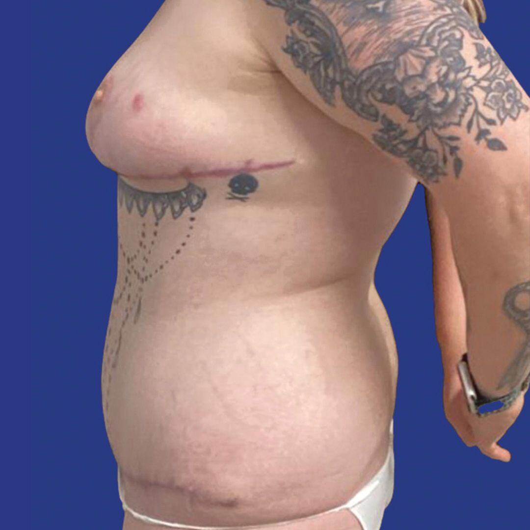 Procedure before and after - after