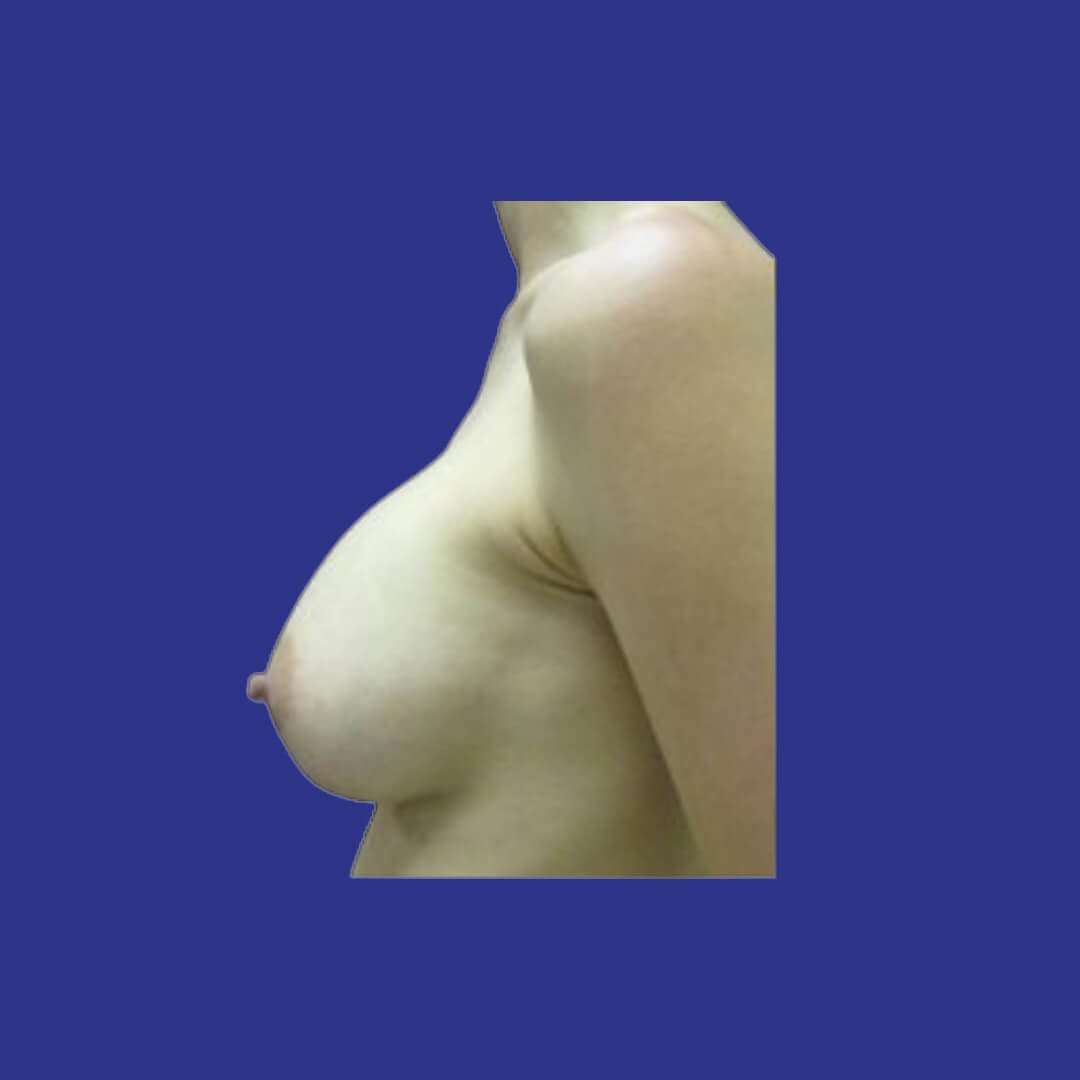 Procedure before and after - after