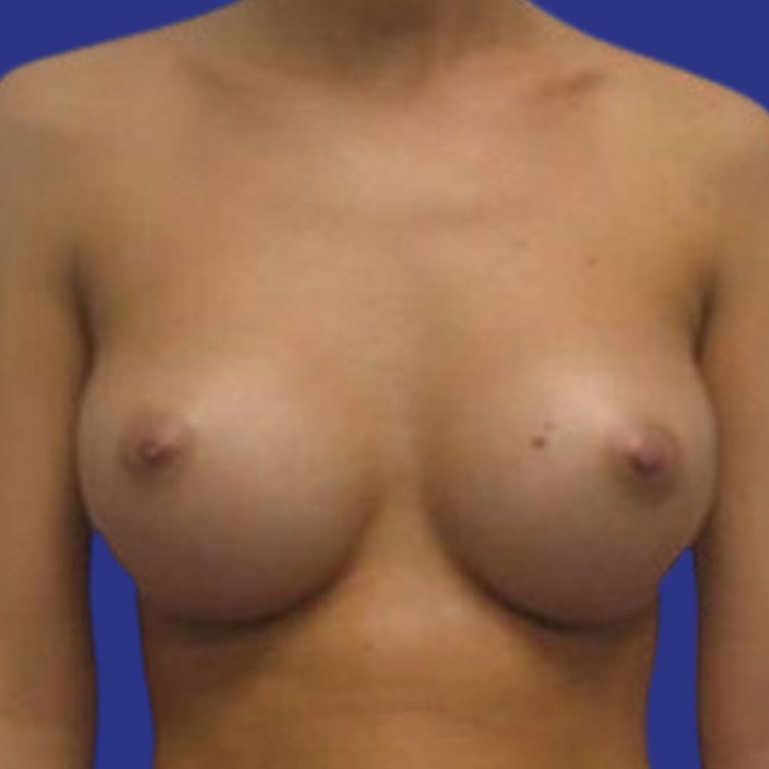 Procedure before and after - after
