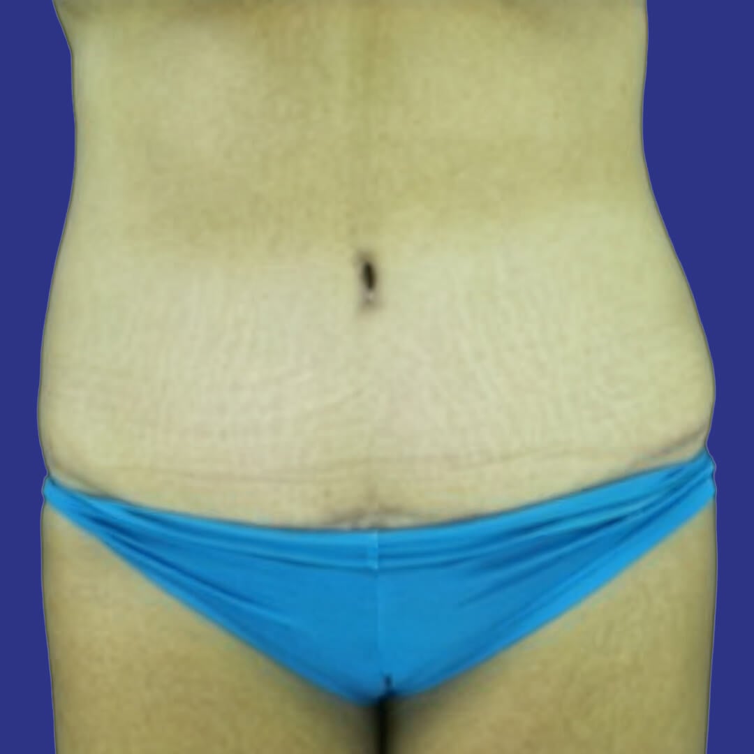 Procedure before and after - after