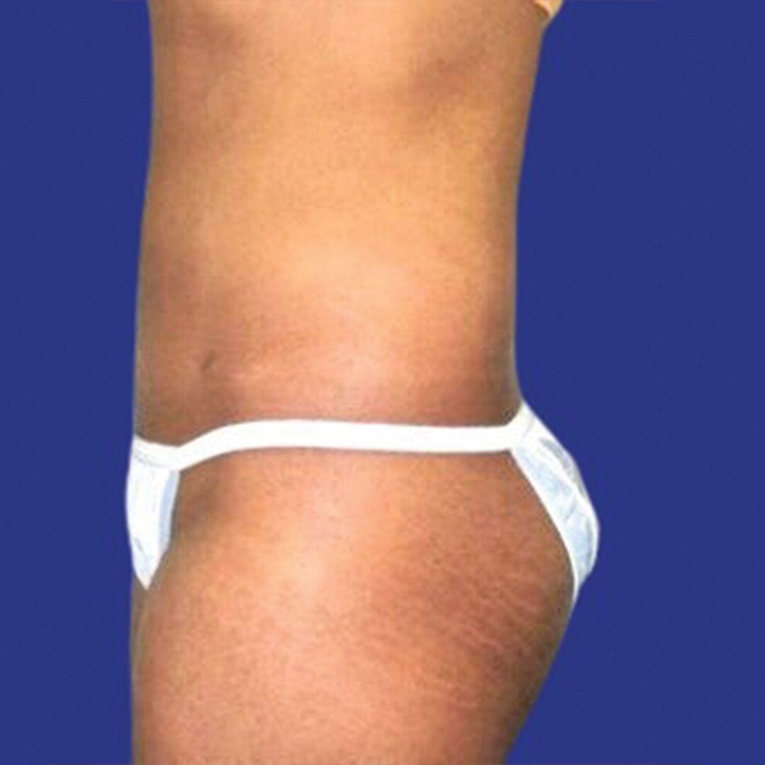 Procedure before and after - after