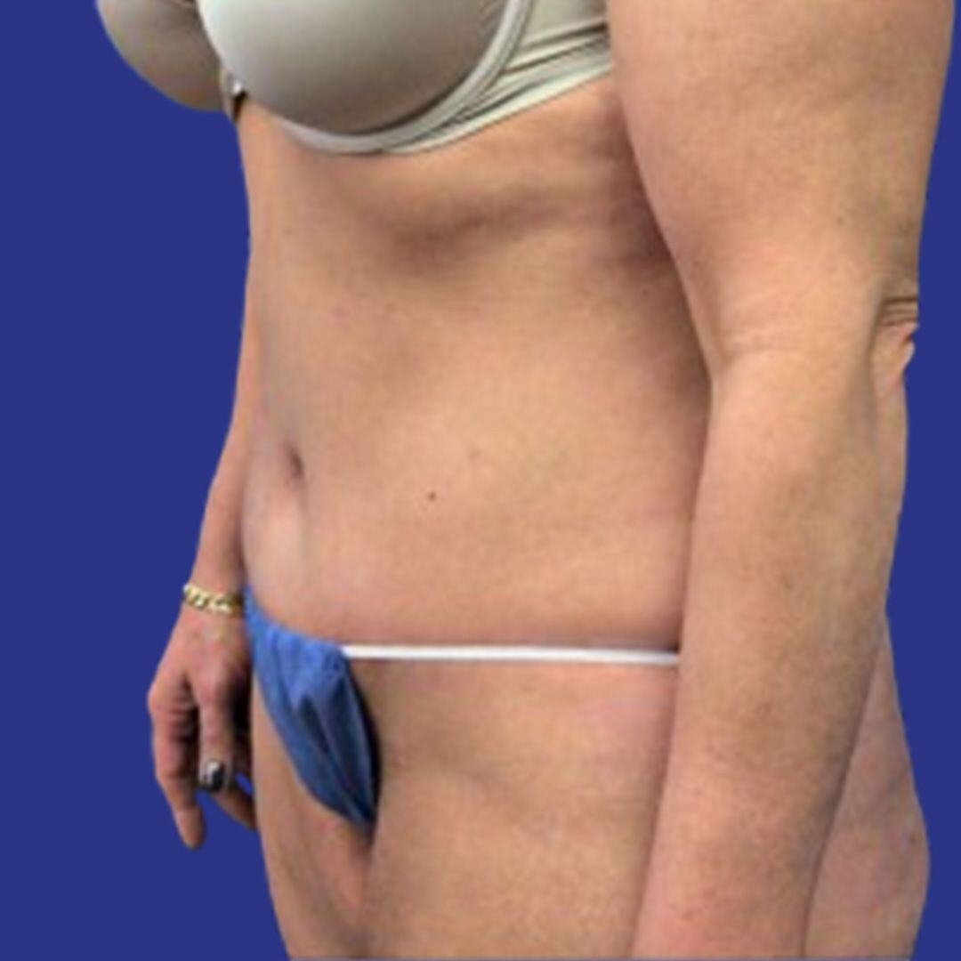 Procedure before and after - after