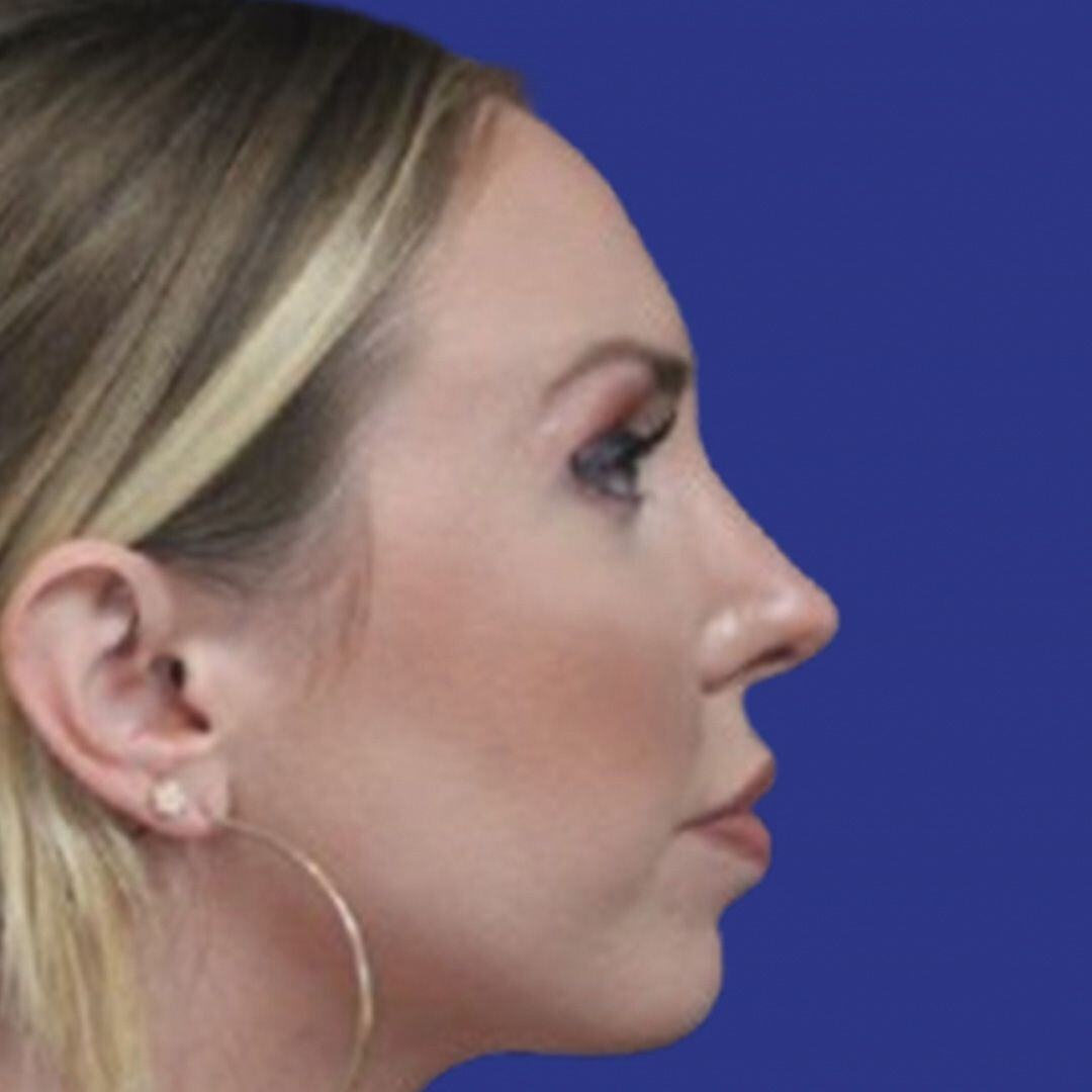 Procedure before and after - after