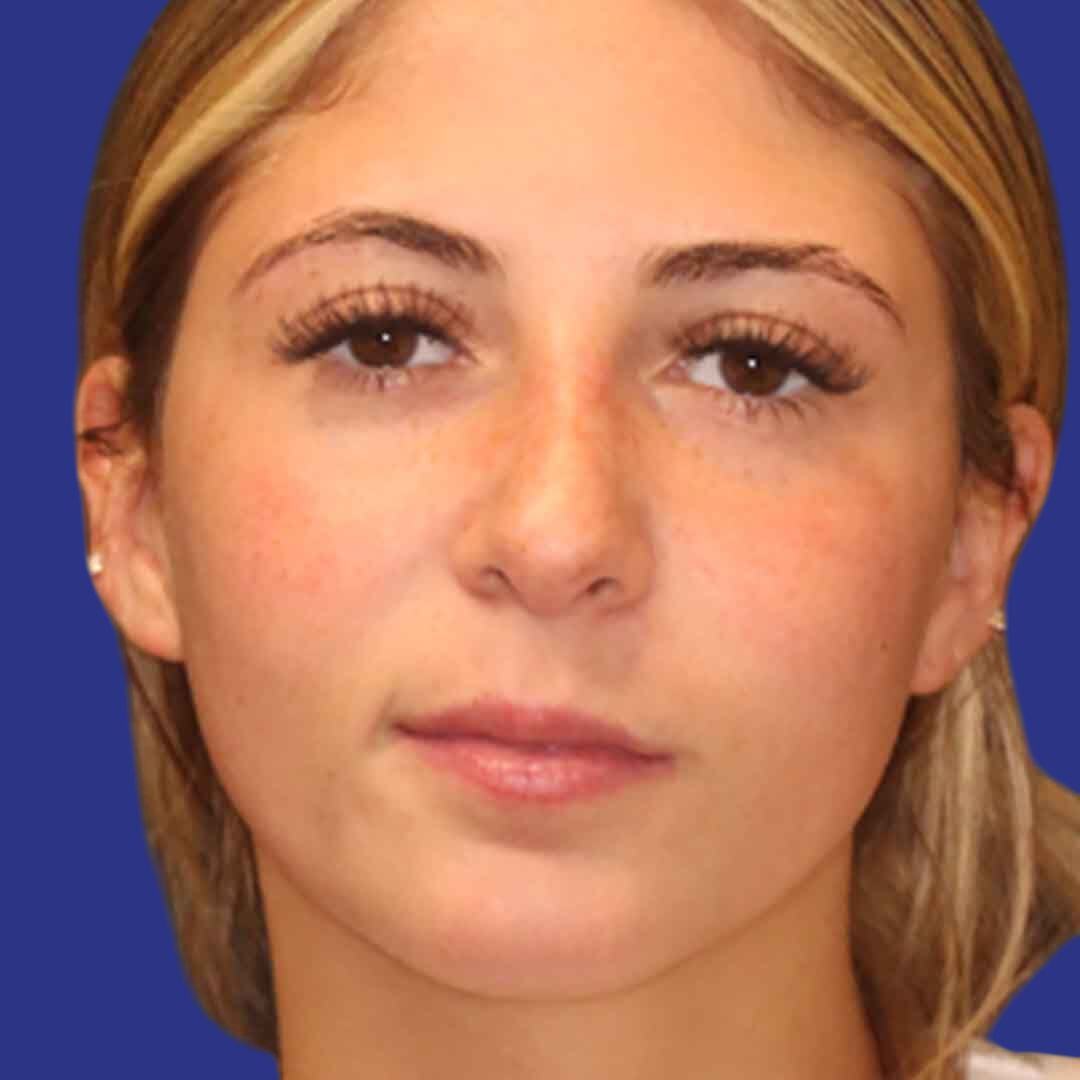 Procedure before and after - after