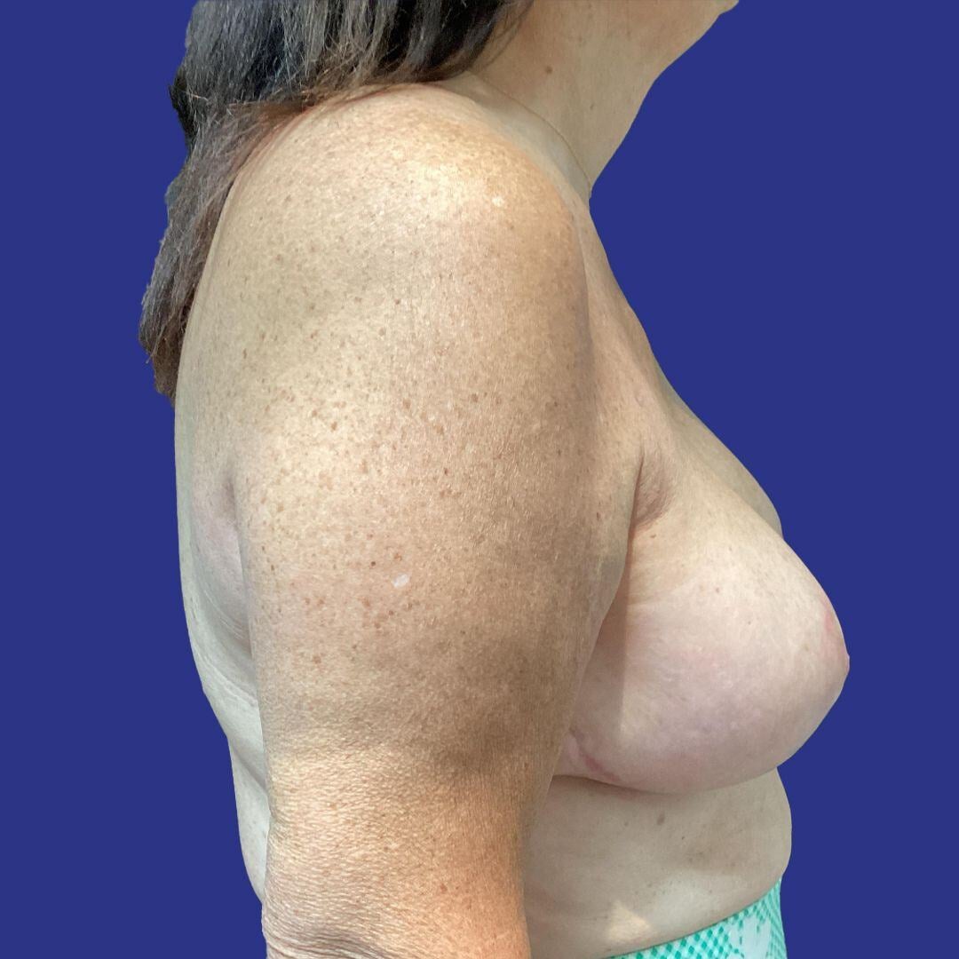 Procedure before and after - after