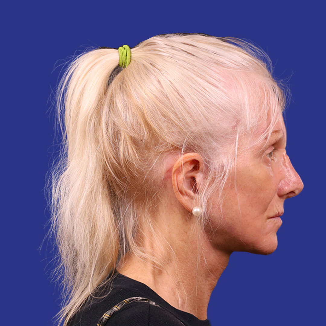 Procedure before and after - after