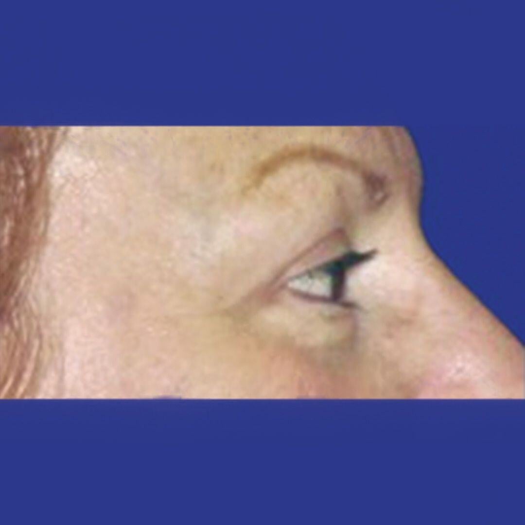 Procedure before and after - after