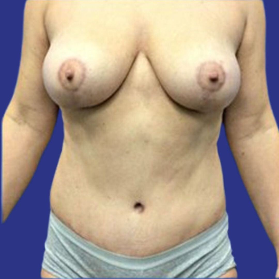 Procedure before and after - after