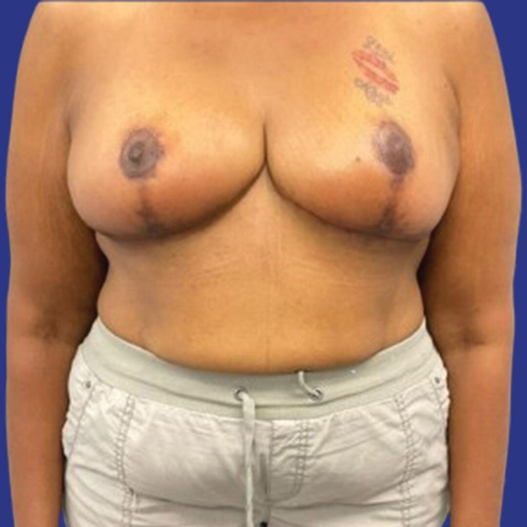 Procedure before and after - after