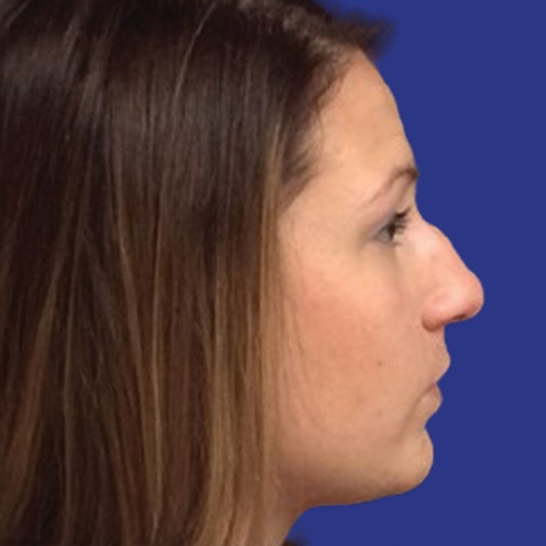 Procedure before and after - after