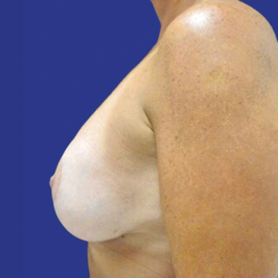 Procedure before and after - after