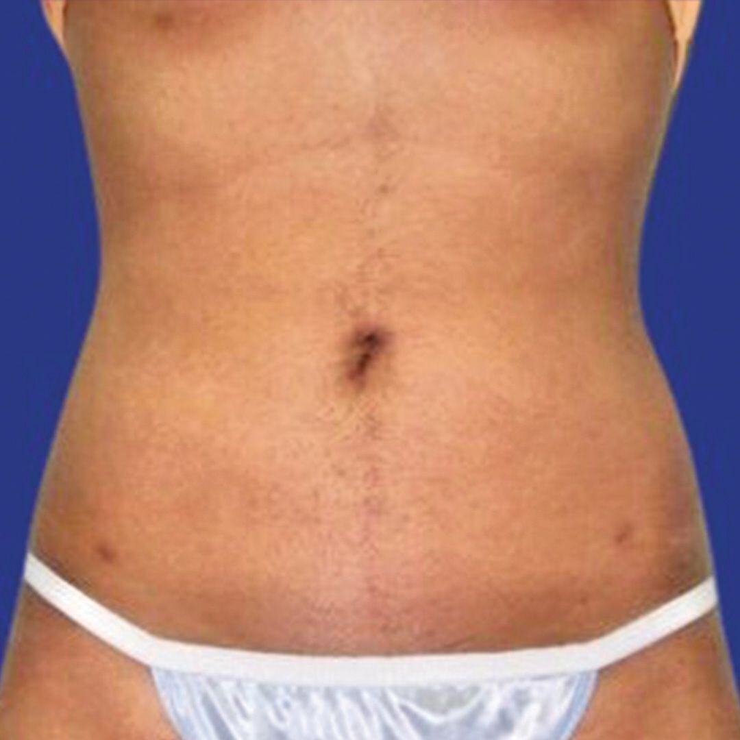 Procedure before and after - after