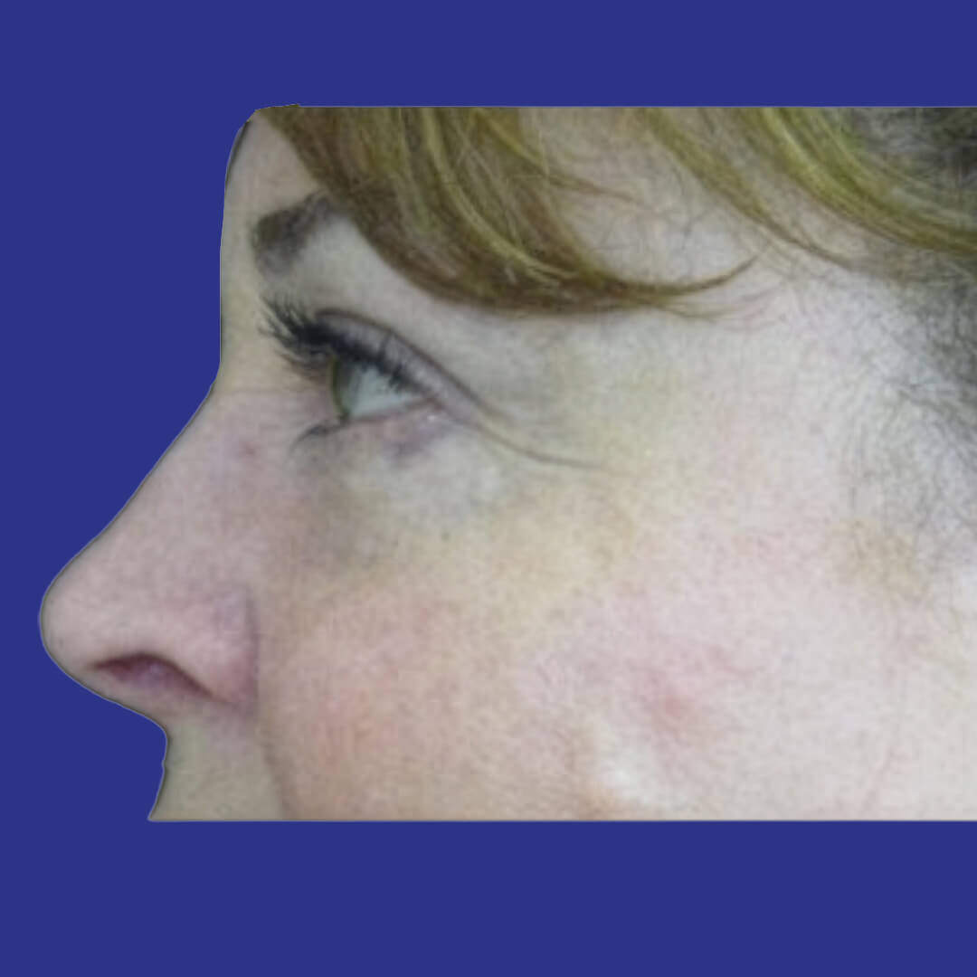 Procedure before and after - after