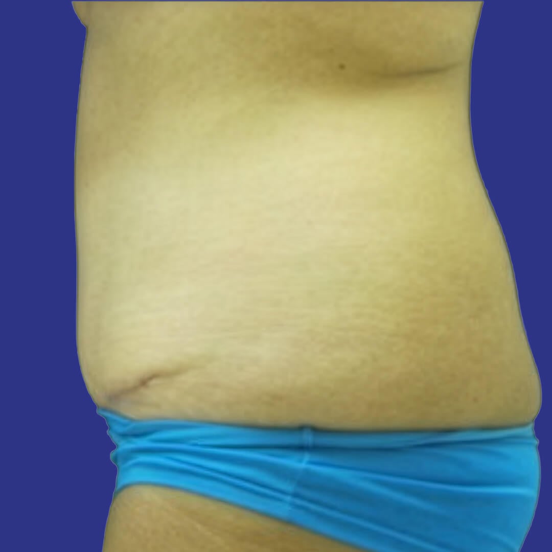 Procedure before and after - after