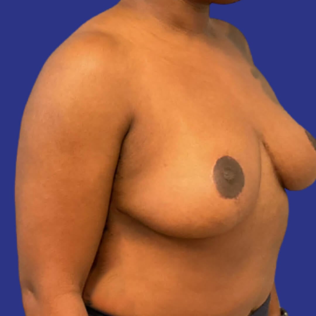 Procedure before and after - after
