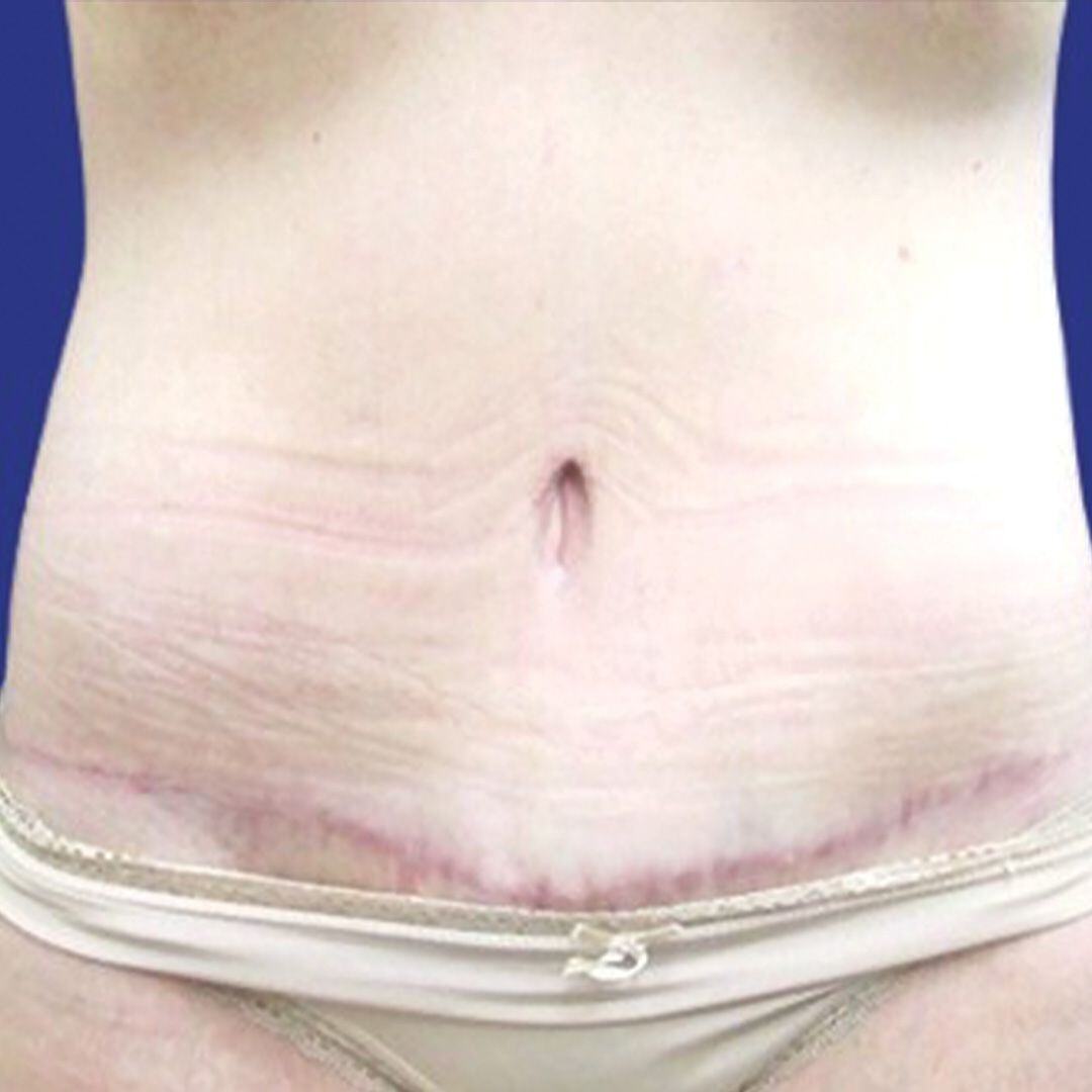 Procedure before and after - after