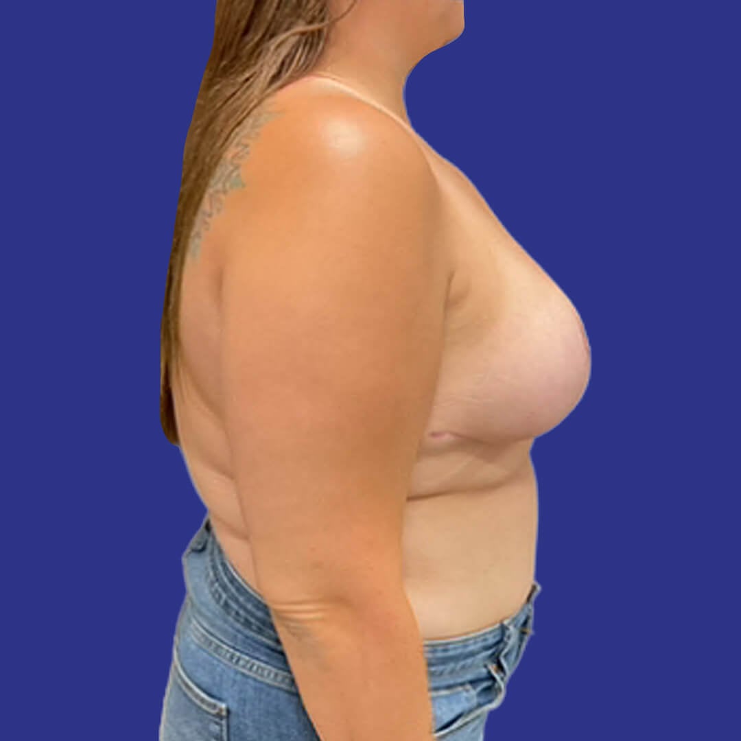 Procedure before and after - after