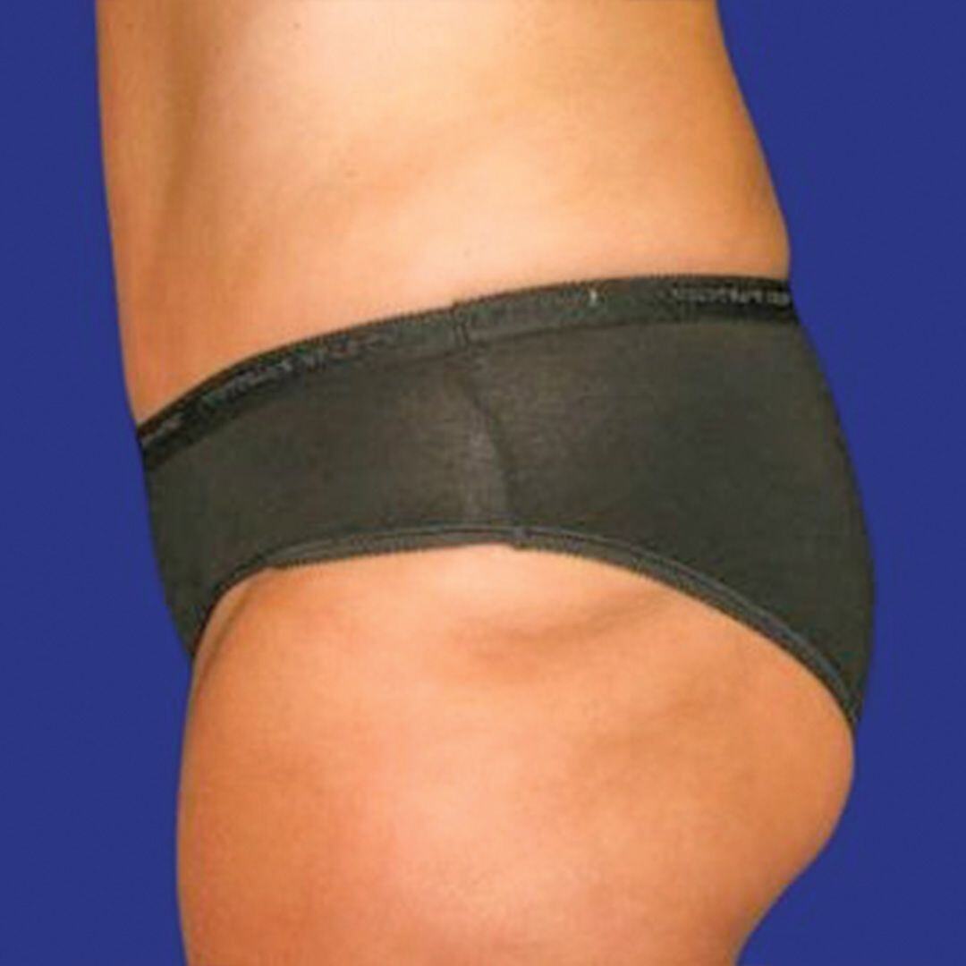 Procedure before and after - after