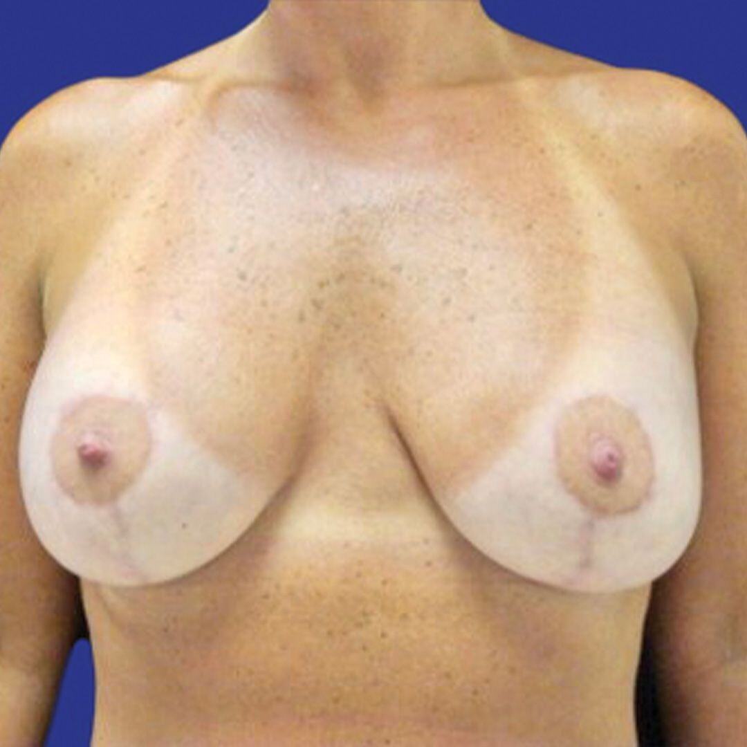 Procedure before and after - after