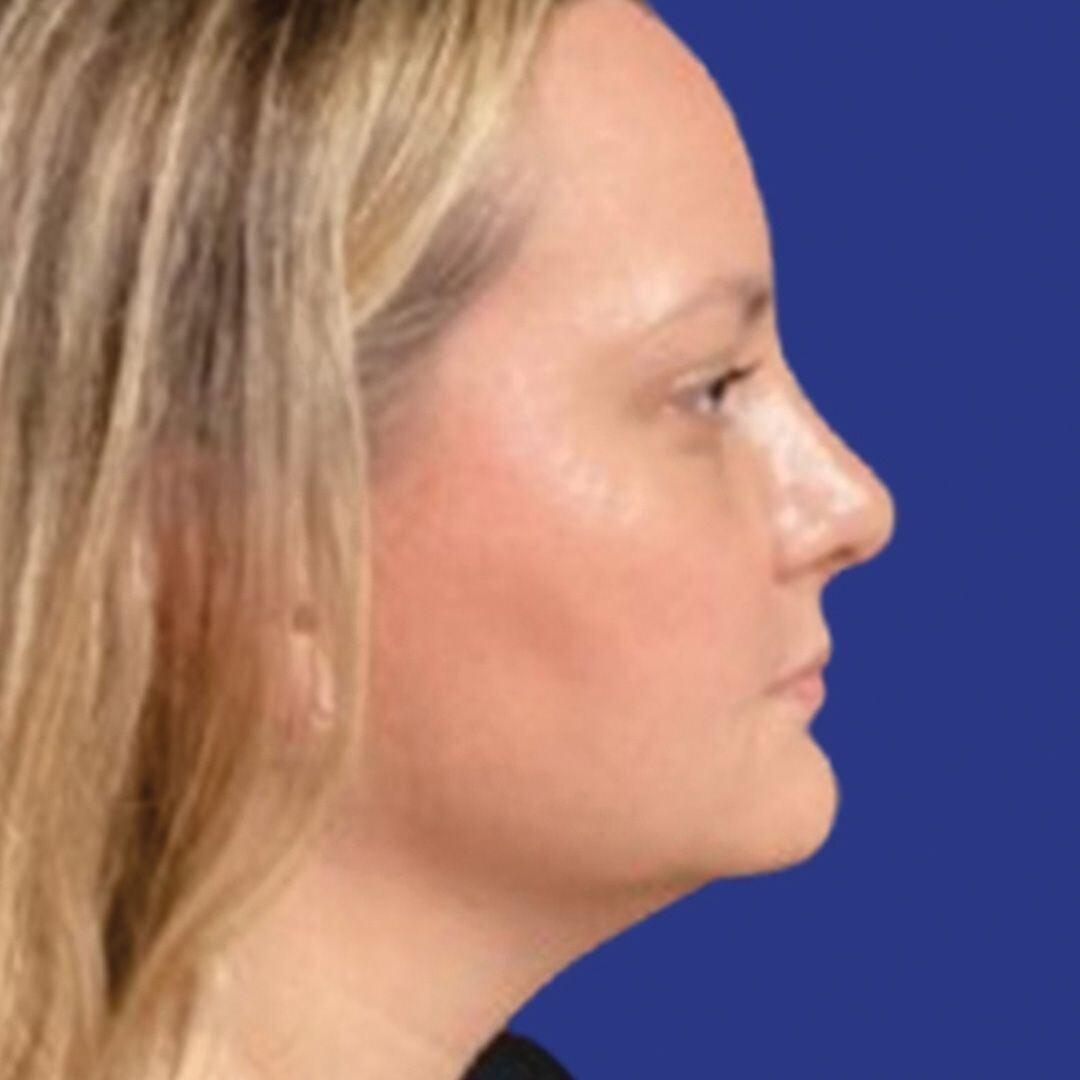 Procedure before and after - after
