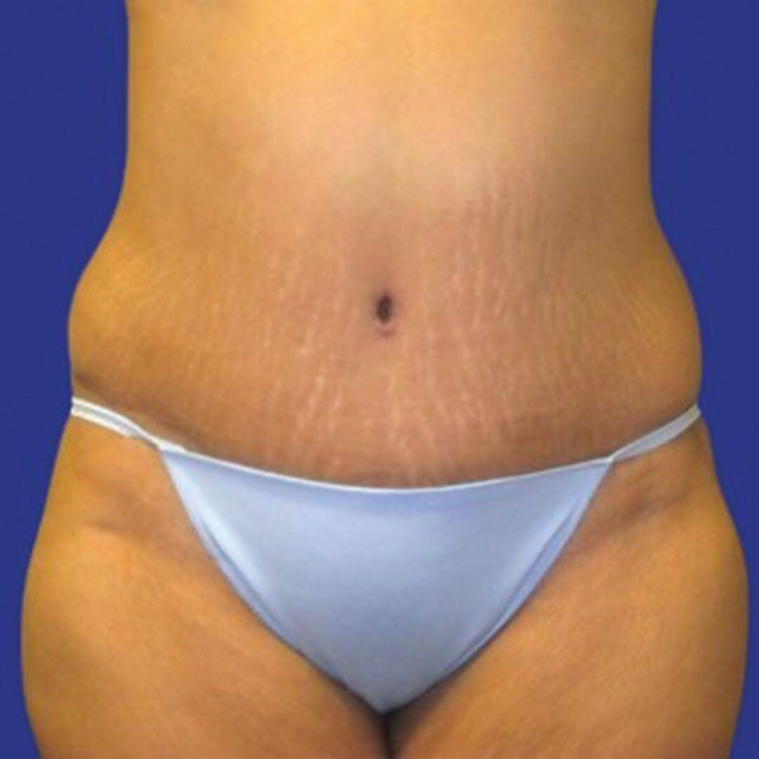Procedure before and after - after