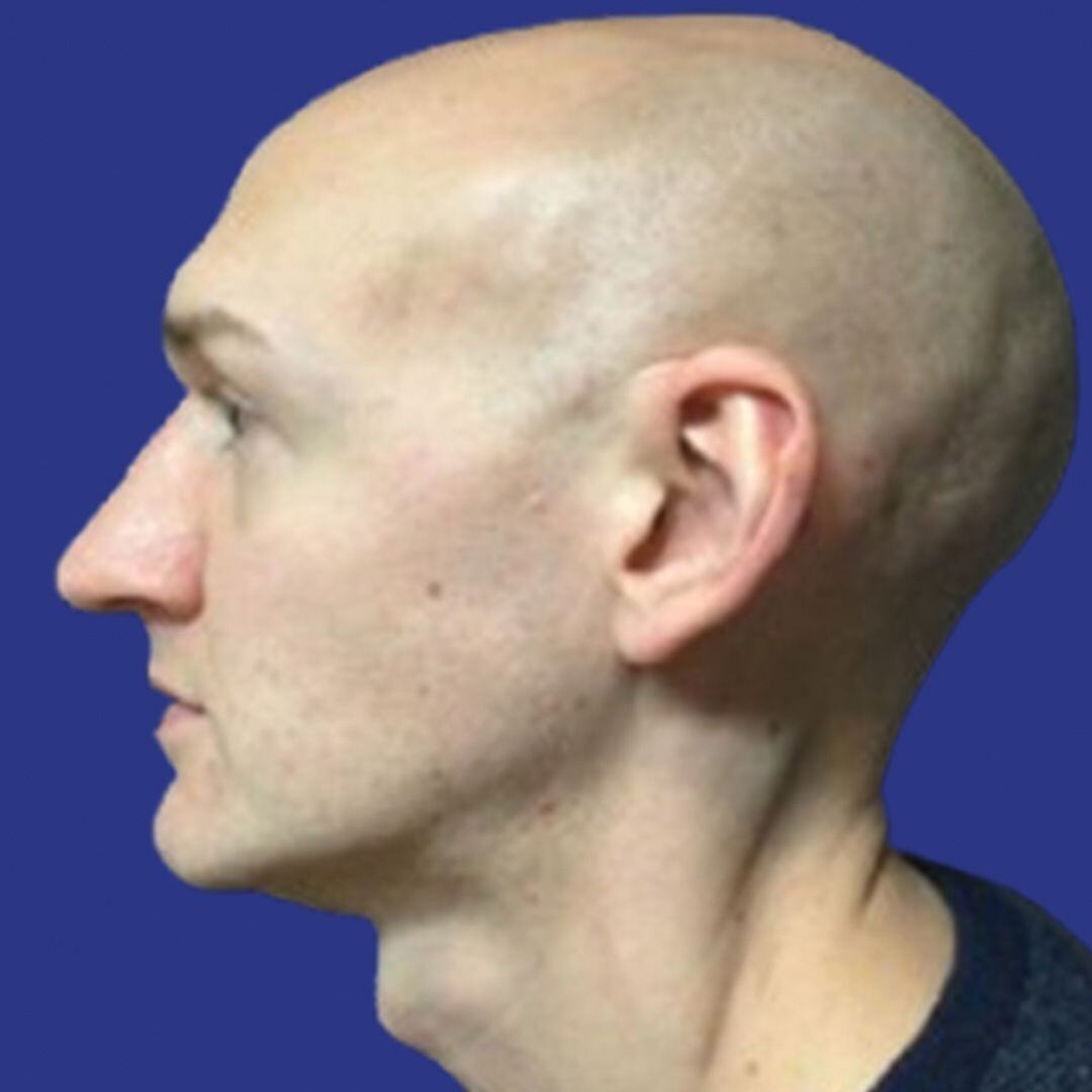 Procedure before and after - after