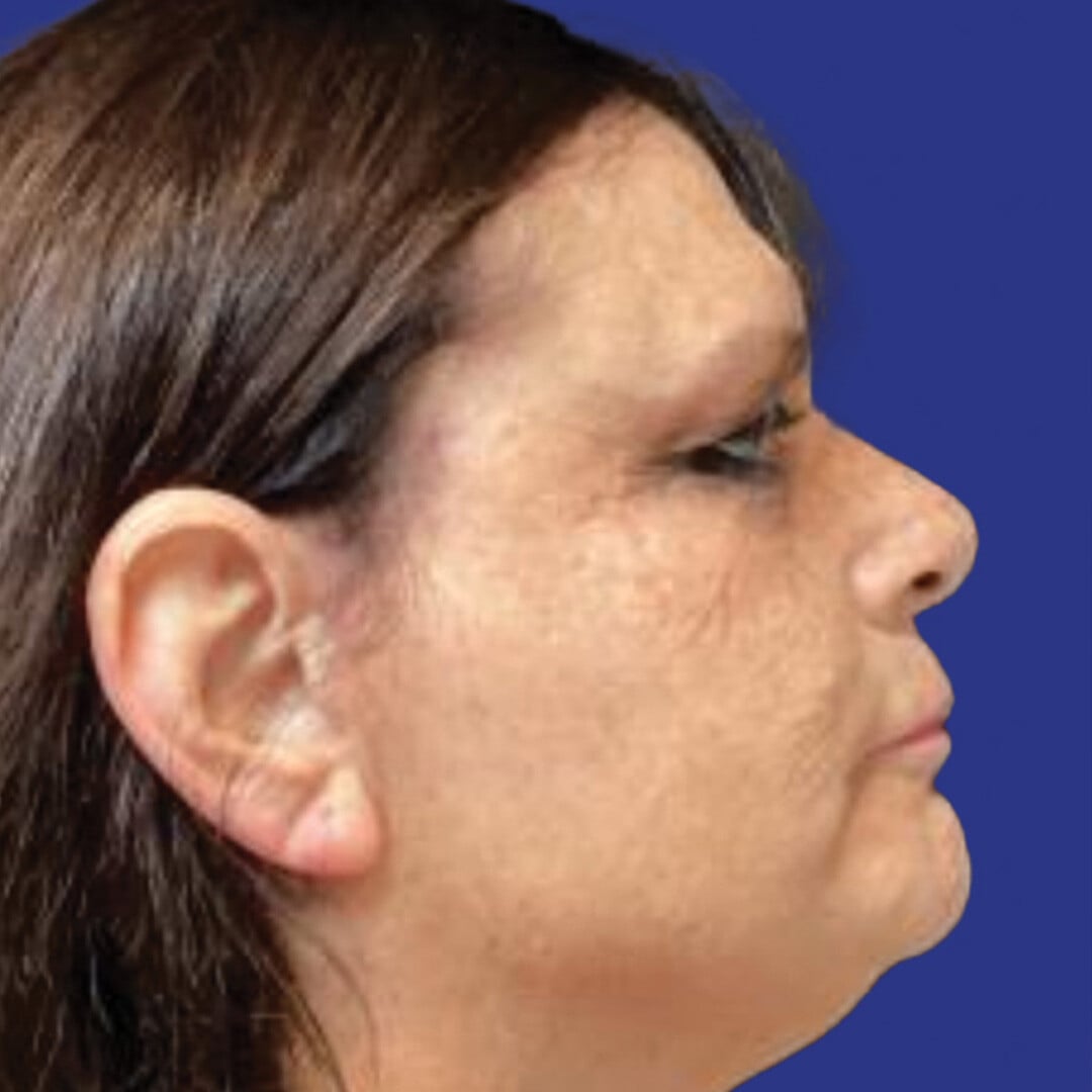 Procedure before and after - after
