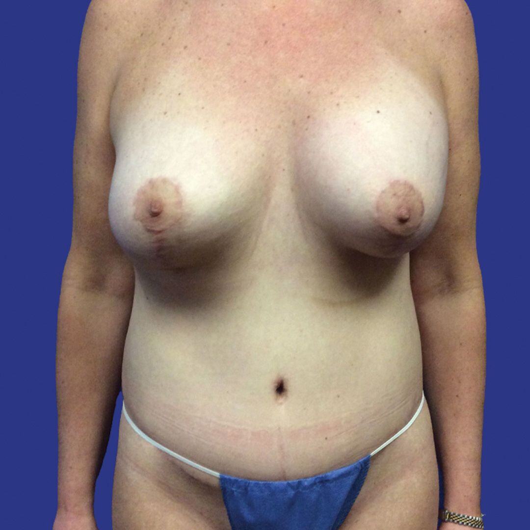 Procedure before and after - after