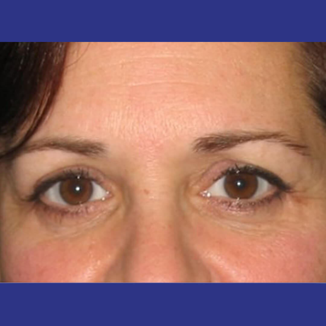 Procedure before and after - after