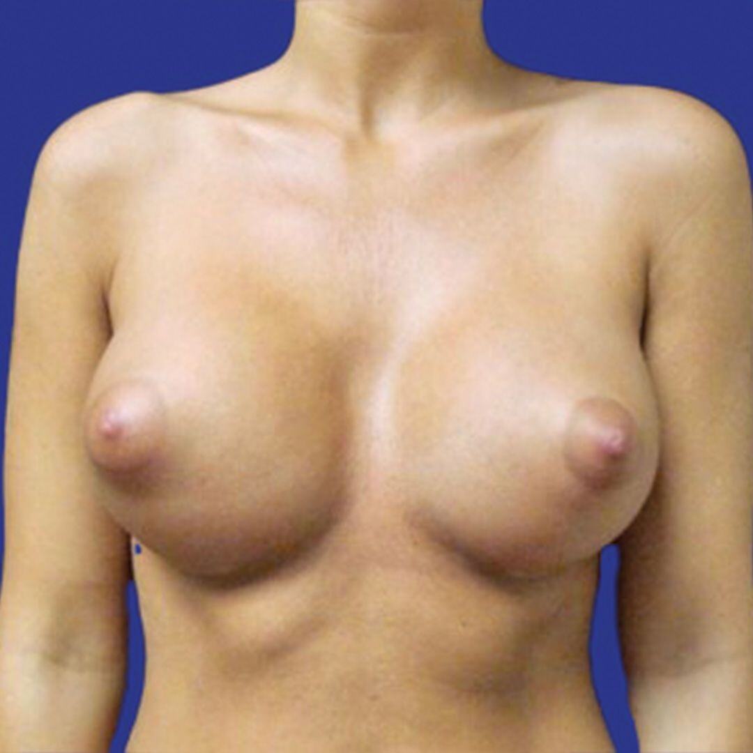 Procedure before and after - after